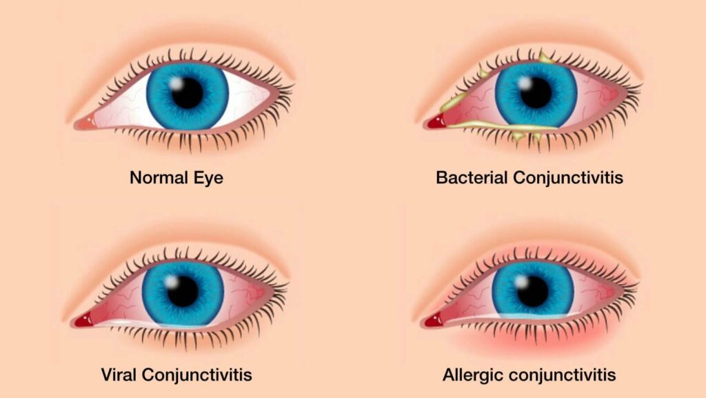 how-long-does-pink-eye-bacteria-live-on-surfaces-the-surprising-truth