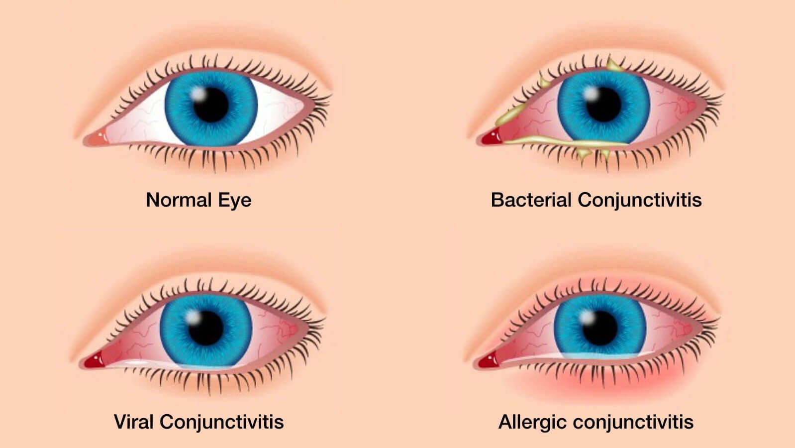 how-long-does-pink-eye-bacteria-live-on-surfaces-the-surprising-truth