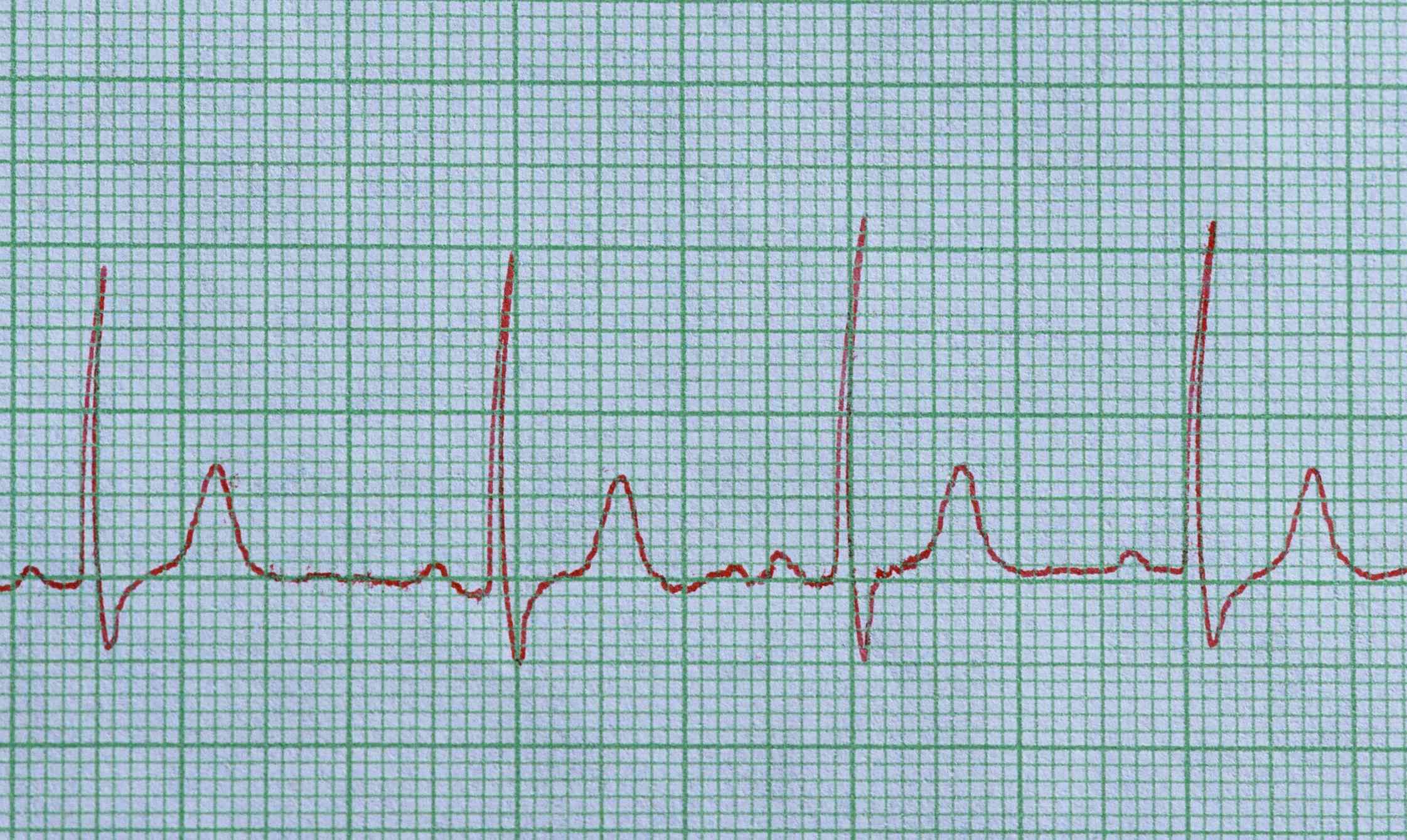 Understanding Sinus Rhythm with Premature Junctional Contractions (PJCs)